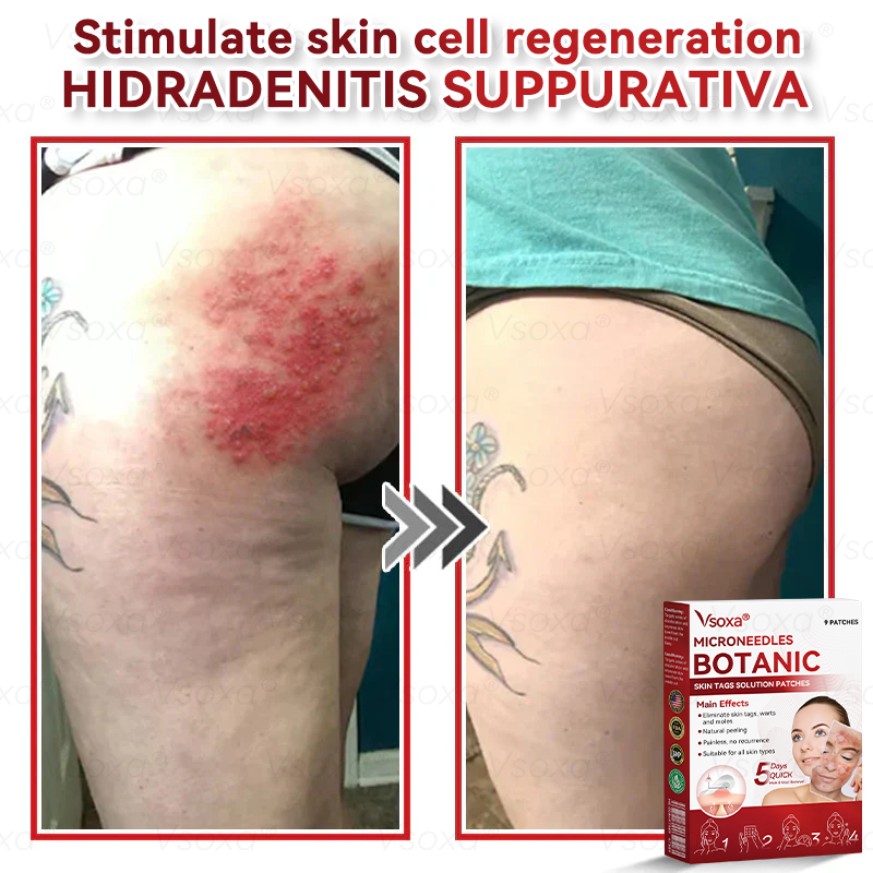 🔥 2025 New Formula ⚡Cvreoz® Microneedle Skin Tag Removal Patches – Visible Results in 5 Days