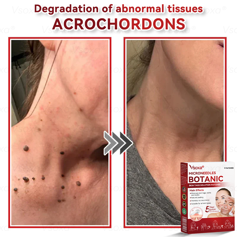 🔥 2025 New Formula ⚡Cvreoz® Microneedle Skin Tag Removal Patches – Visible Results in 5 Days