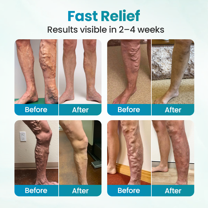 Croaie® VeinAway Relief Cream