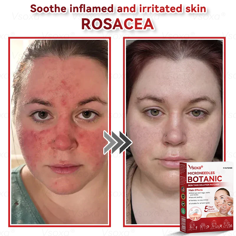 🔥 2025 New Formula ⚡Cvreoz® Microneedle Skin Tag Removal Patches – Visible Results in 5 Days