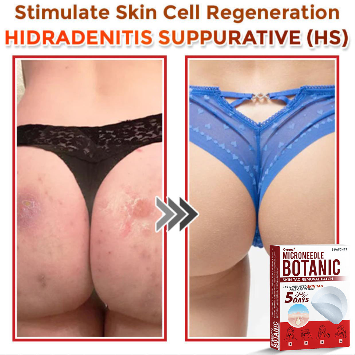 Cvreoz® MicroNeedle Botanic Skin Tag Removal Patch 🇺🇸 Made in the USA