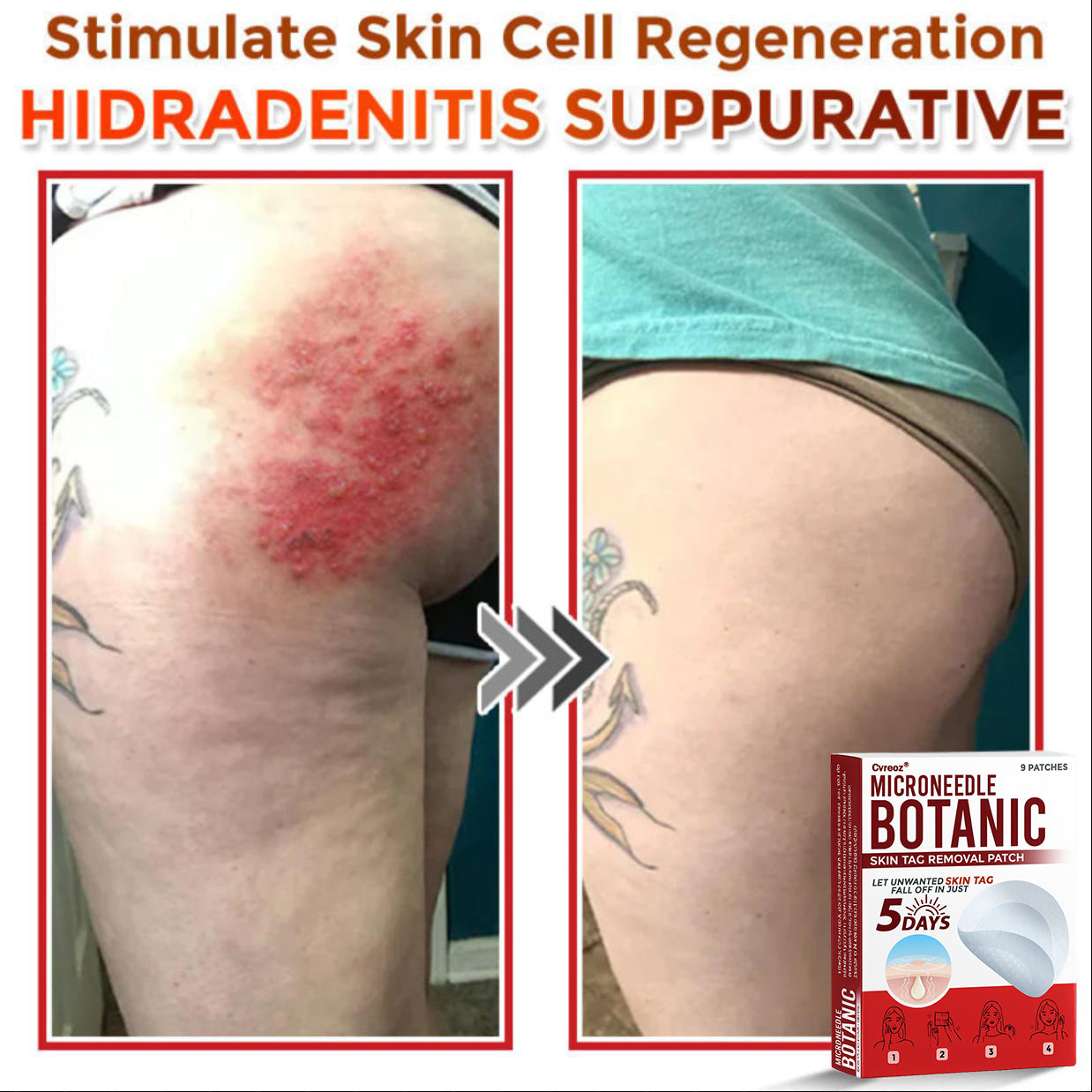 Cvreoz® MicroNeedle Botanic Skin Tag Removal Patch 🇺🇸 Made in the USA