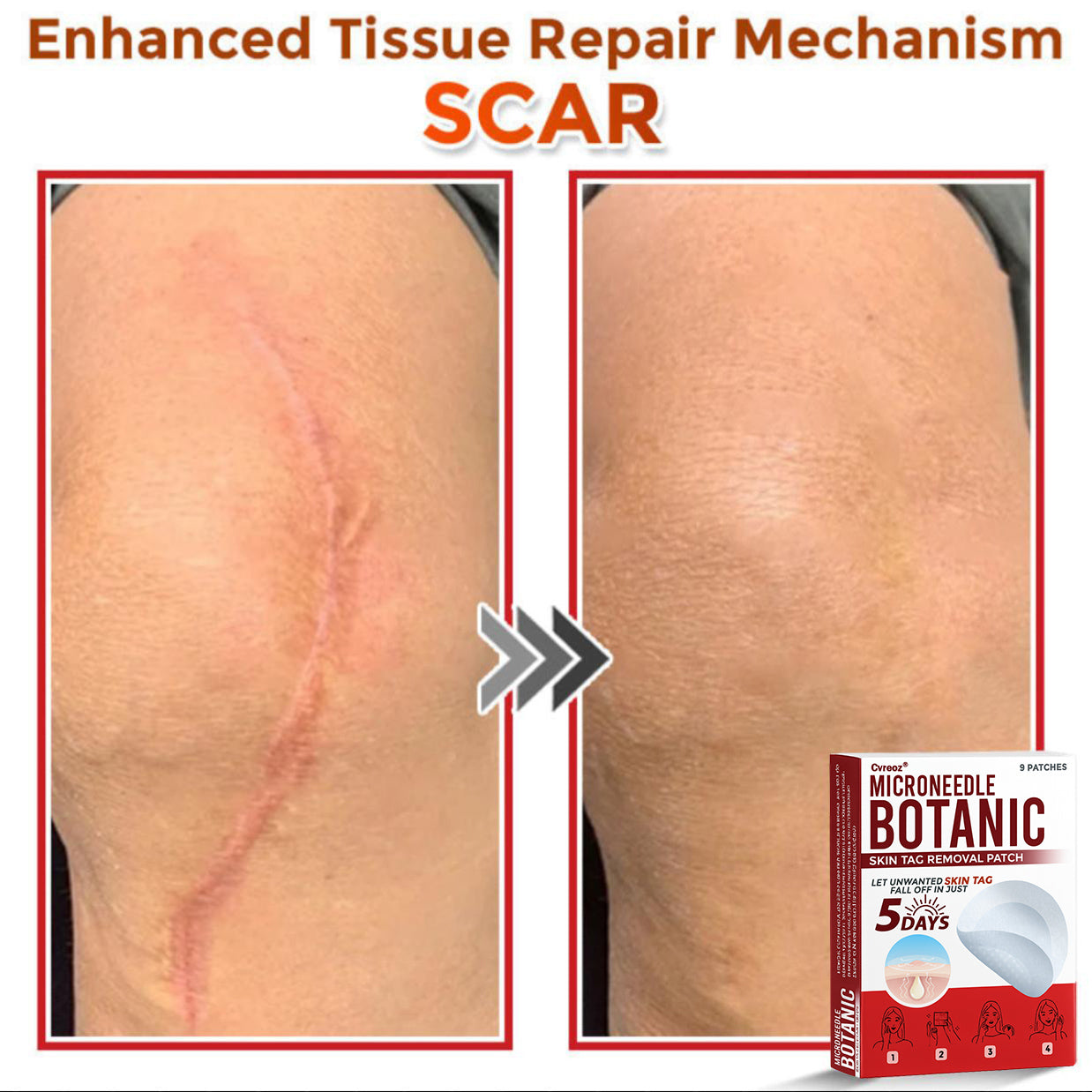 Cvreoz® MicroNeedle Botanic Skin Tag Removal Patch 🇺🇸 Made in the USA