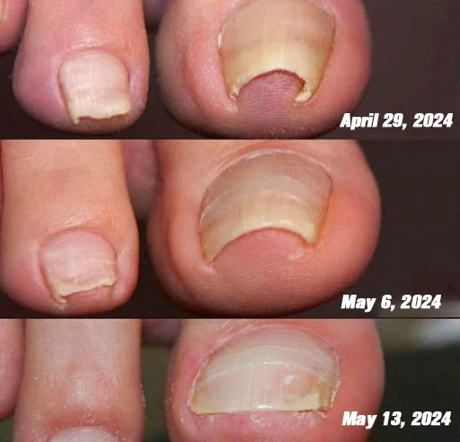 KUBOZN™ Bee Venom Nail Fungus Treatment Solution👣