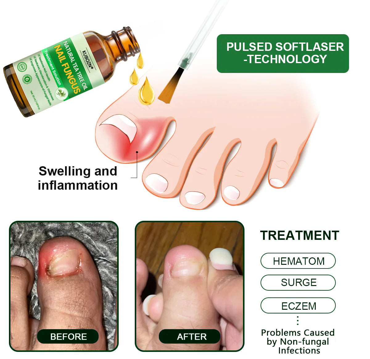 KUBOZN® Antifungal Nail Fungus Treatment Serum – Clear, Strong Nails👣