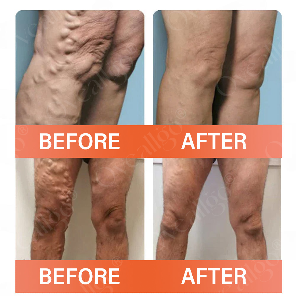 Mresio® VeinEase Microneedle Therapy Patch
