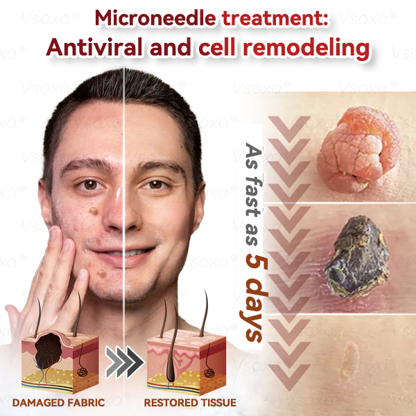 🔥 2025 New Formula ⚡Cvreoz® Microneedle Skin Tag Removal Patches – Visible Results in 5 Days
