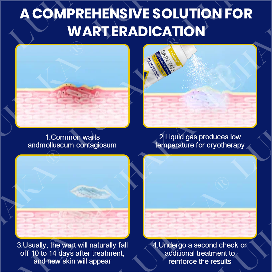 LUHAKA® SKIN TAG CRYO TREATMENT SPRAY ACE