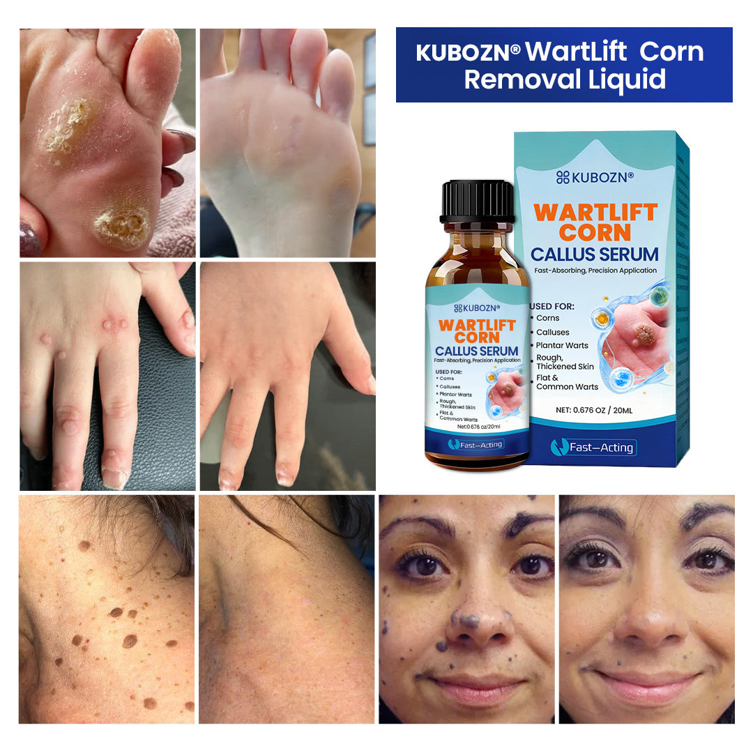 KUBOZN® WartLift Corn Removal Liquid