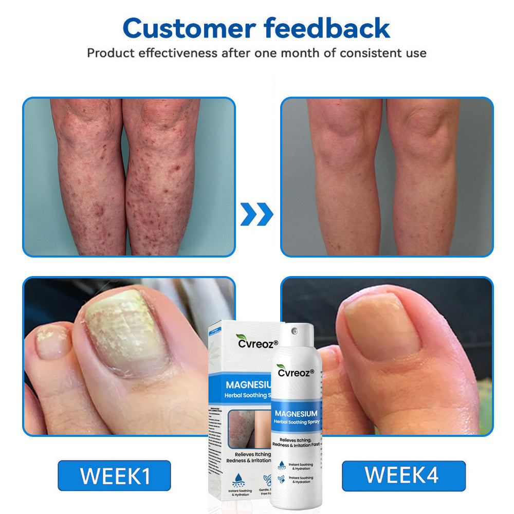✅  Official Store: Cvreoz® Magnesium Herbal Psoriasis Spray ⚕️ FDA Certified (for the treatment of psoriasis and eczema, improvement of bacterial infections in the genital area, treatment of acne and warts, eliminates psoriasis and eczema, etc.)