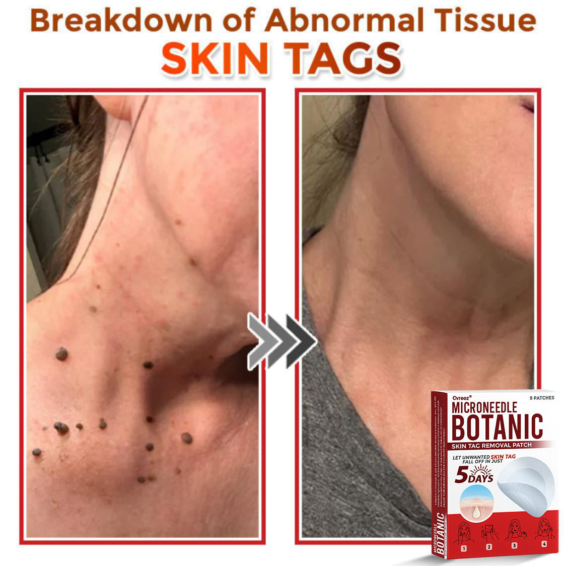 Cvreoz® MicroNeedle Botanic Skin Tag Removal Patch 🇺🇸 Made in the USA