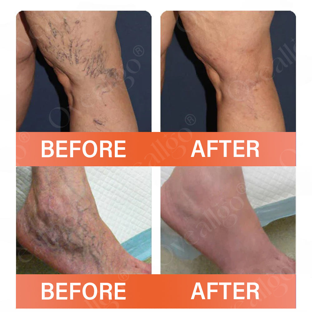 Mresio® VeinEase Microneedle Therapy Patch