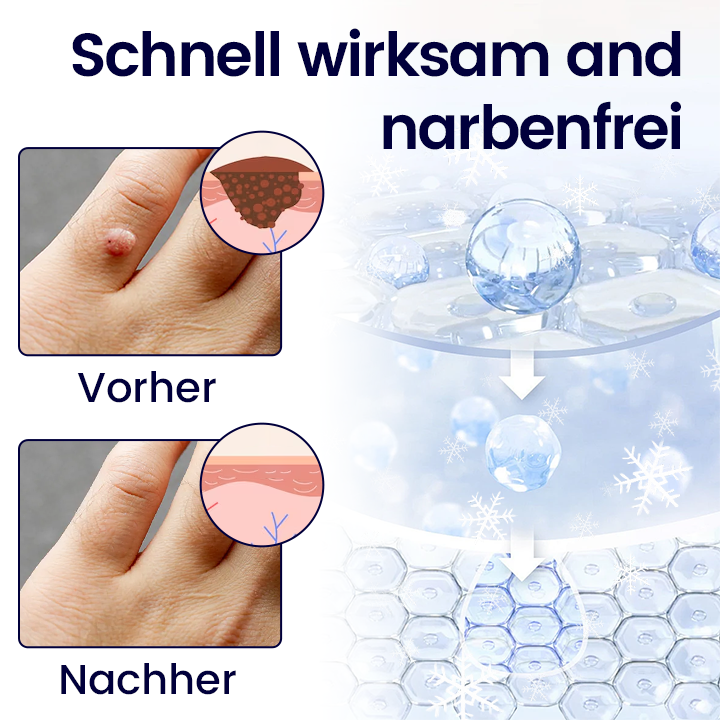 Cvreoz® WartErase Kryo-Freeze Spray