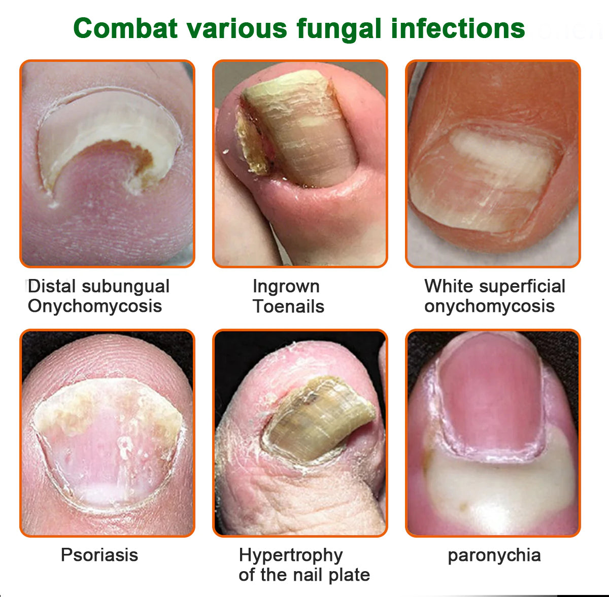 KUBOZN® Antifungal Nail Fungus Treatment Serum – Clear, Strong Nails👣