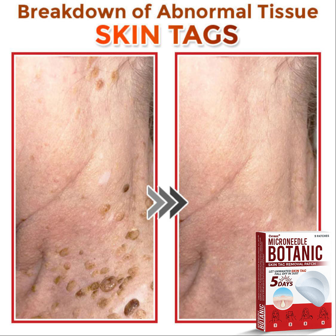 Cvreoz® MicroNeedle Botanic Skin Tag Removal Patch 🇺🇸 Made in the USA