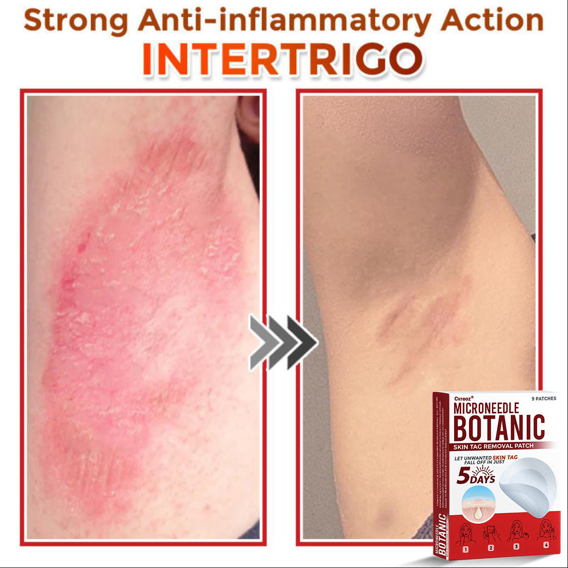 Cvreoz® MicroNeedle Botanic Skin Tag Removal Patch 🇺🇸 Made in the USA