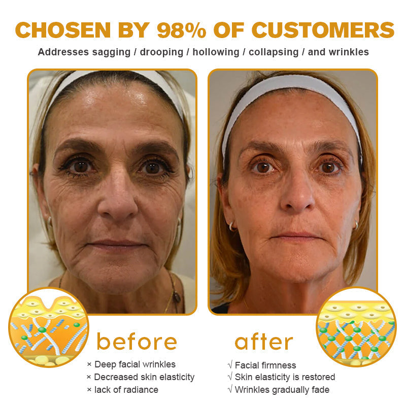 (🔥Made and Shipped from UK✅) Ourlyard® Botox Bee Venom Wrinkle Removal Microdarts Patch- LAST DAY 60% OFF