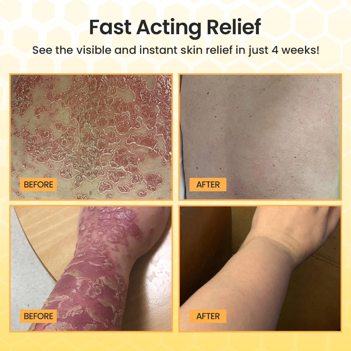 Luhaka® Bee Venom Psoriasis Cream 🐝4